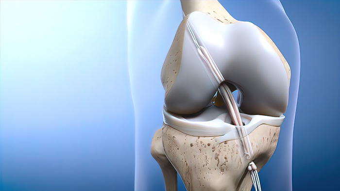 Arthroscopic Anterior Cruciate Ligament Reconstruction