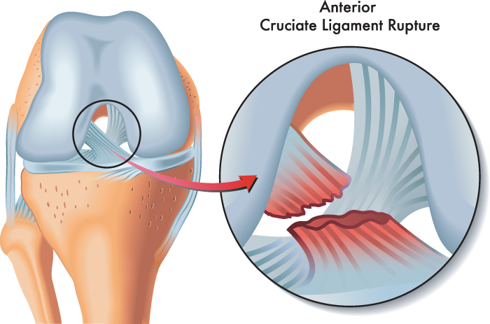 Anterior Cruciate Ligament (ACL)