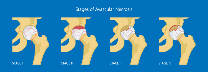 Avascular Necrosis