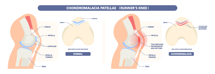 Chondromalacia Patella