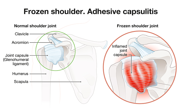 What is a frozen shoulder