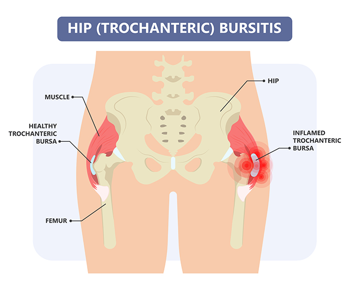 Trochanteric Bursitis