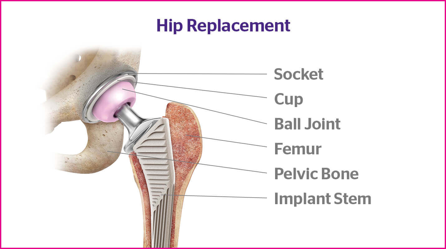 Total Hip Replacement