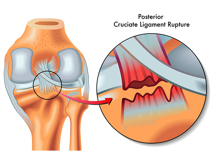 Posterior Cruciate Ligament Injuries