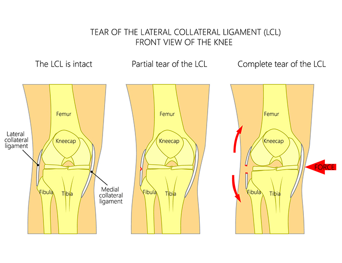 Lateral Patellar Compression Syndrome