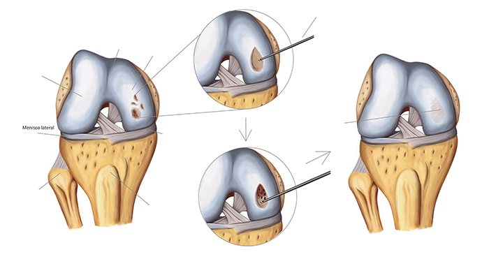 Chondral (Articular Cartilage) Defects