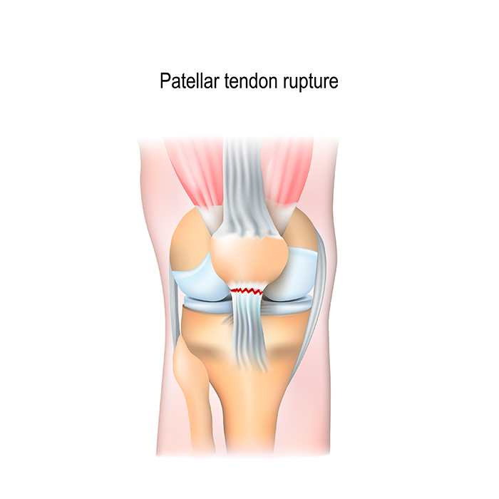 Patella Tendon Rupture