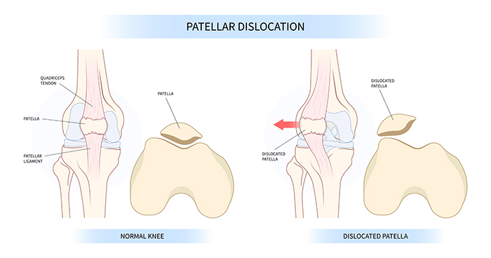 Patellar Dislocation