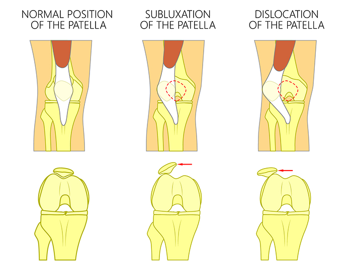 Patellar Instability