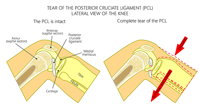 Posterior Cruciate Ligament Tear & Reconstruction