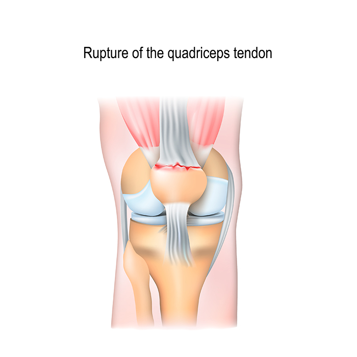 Quadriceps Tendon Rupture