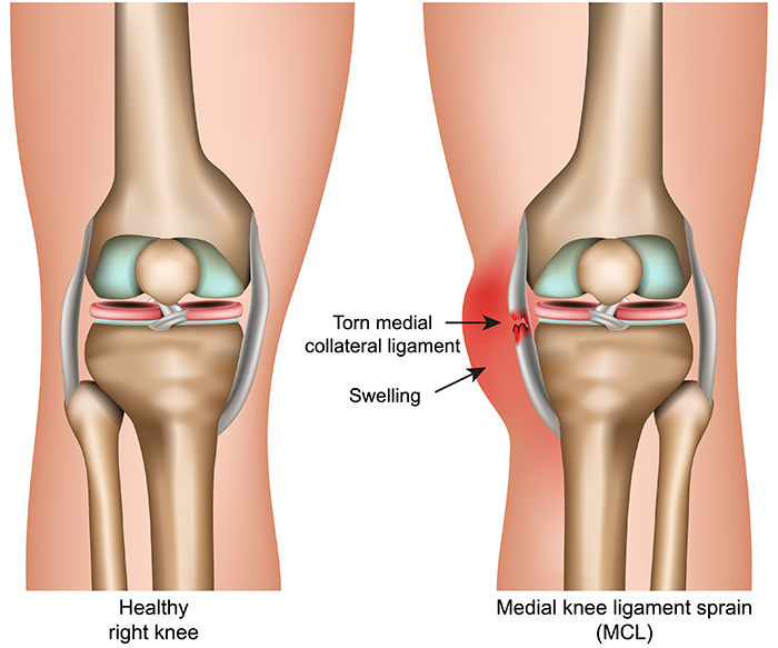 The Medial Collateral Ligament (MCL)