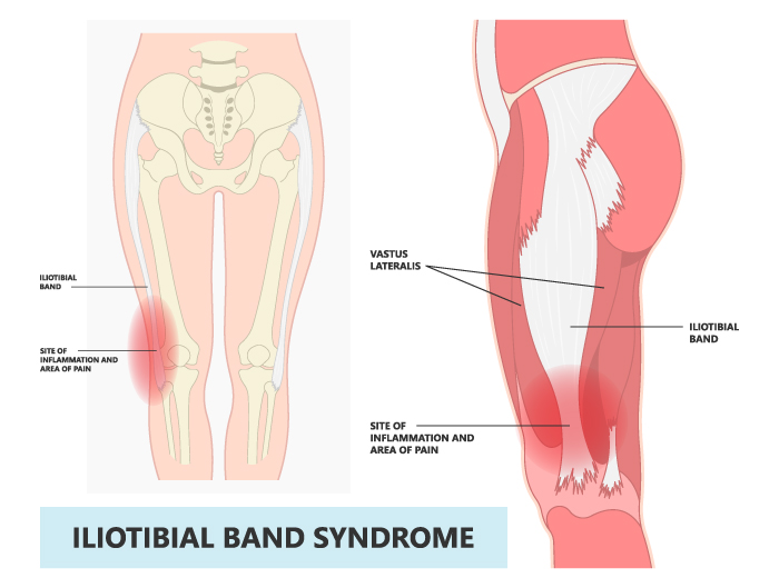 Iliotibial Band Syndrome