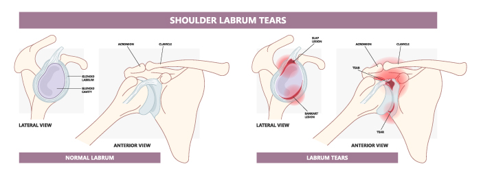 Anterior Instability