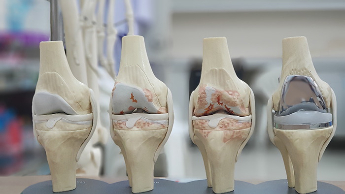 Knee Arthritis