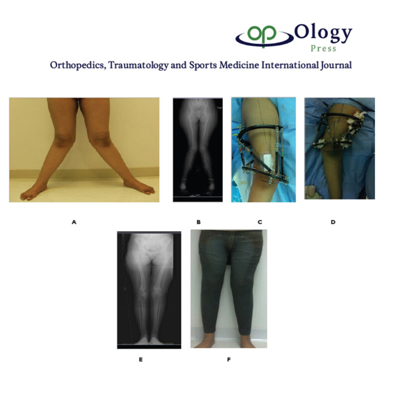 Correction of Deformities Around the Knee and Tibia Using Taylor ...